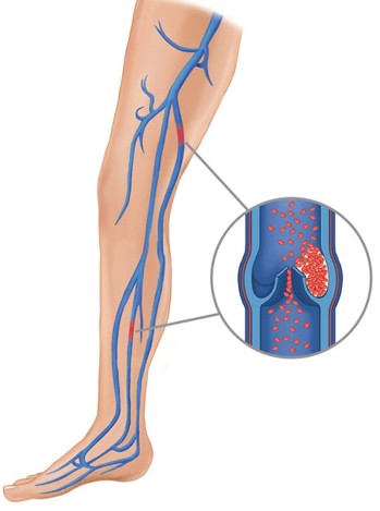 Causes of varicose veins(1)