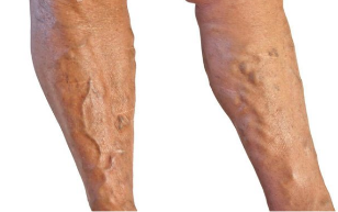 Treatment of varicose veins in legs.