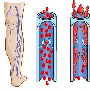 What do a normal vein and a vein look like in varicose veins 
