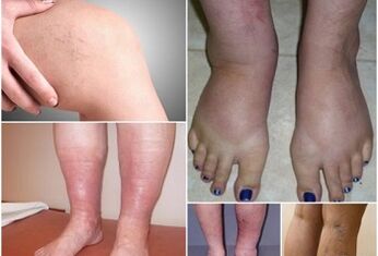 Photos of varicose veins on the legs