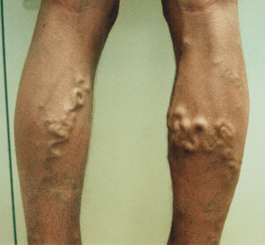 Traditional varicose vein treatment