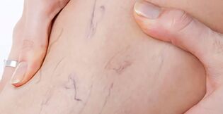 First signs of varicose veins