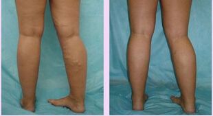 How does the first stage varicose veins manifest