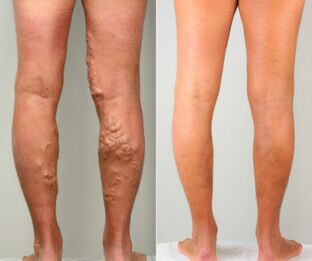 Stages of varicose veins in the legs