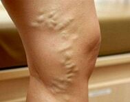 Varicose veins of lower extremities during pregnancy