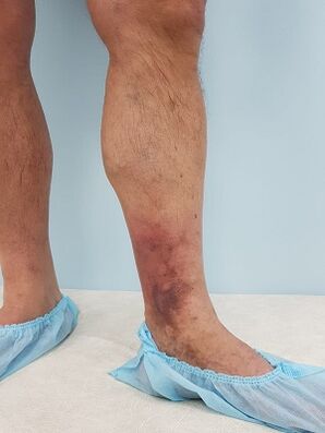 Complications of varicose veins in men