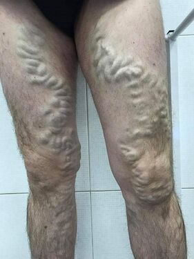 Neglected male varicose veins