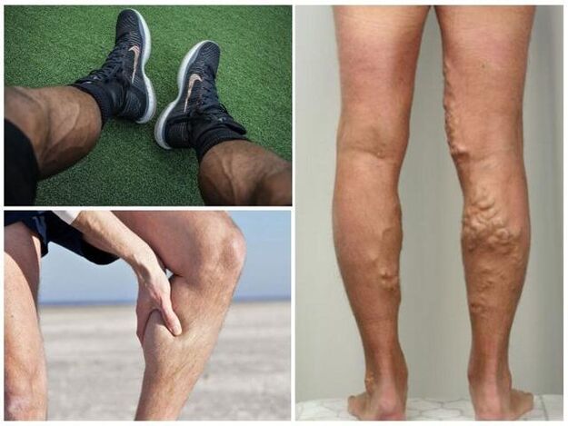What do varicose veins on a man’s legs look like
