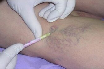 Sclerotherapy as a treatment for varicose veins