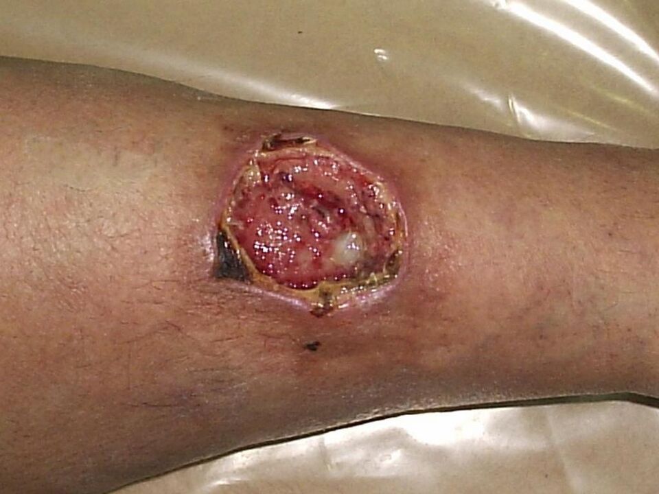 Nutritional ulcers of advanced varicose veins
