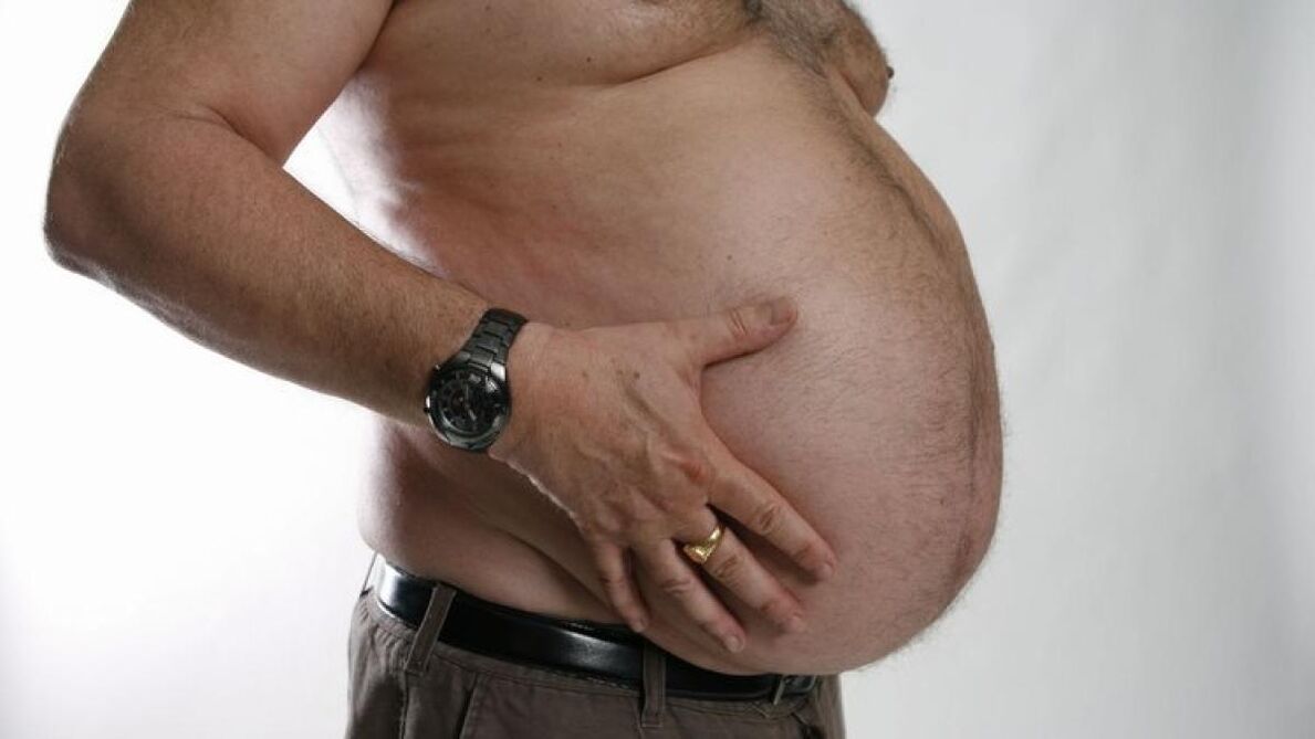 Obesity is a cause of the development of varicose veins