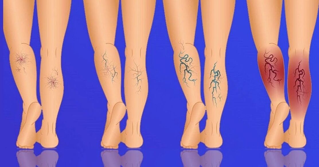 Stages of development of varicose veins