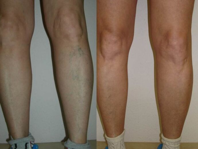 Laser treatment of legs before and after varicose veins