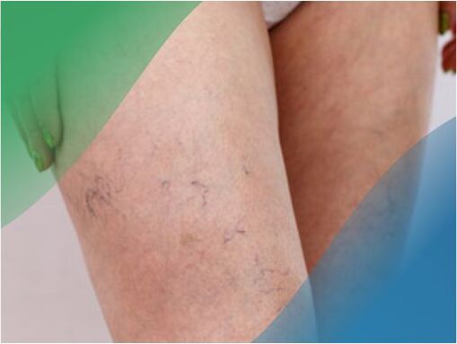 A network of blood vessels in the legs is one of the symptoms of varicose veins