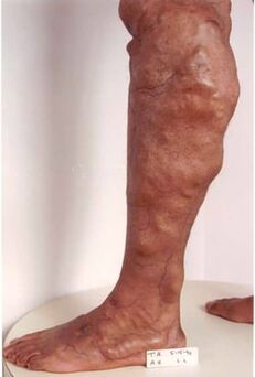 Manifestations of chronic venous insufficiency of the lower extremities