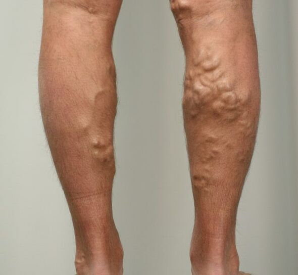 Varicose veins in the legs