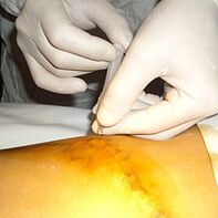 Veneectomy is the most cosmetic treatment for varicose veins