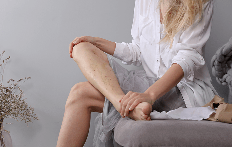 Varicose veins in the legs