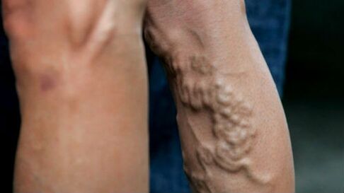 Manifestations of late varicose veins of the lower extremities