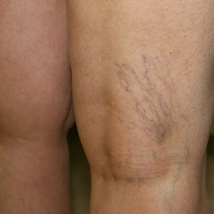 The venous network of the lower limbs is a sign of varicose veins