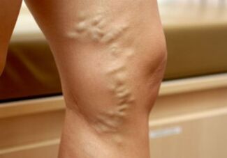Varicose veins on woman's legs