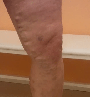 Varicose veins