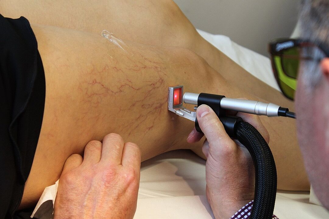 Laser blood coagulation