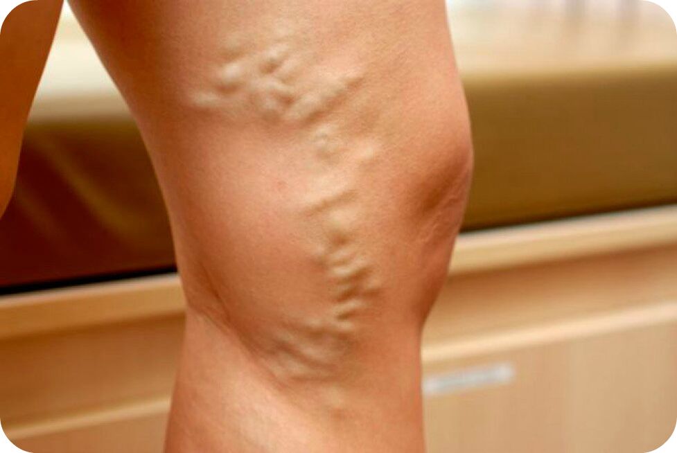 Varicocele veins in the vein