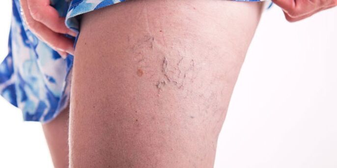 Prevent varicose veins