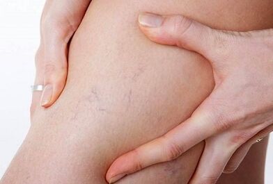 The prohibition of varicose veins