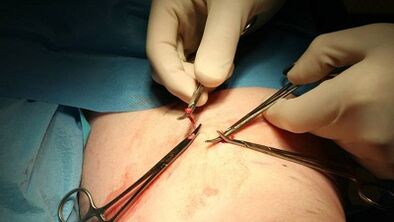 Venous vein removal