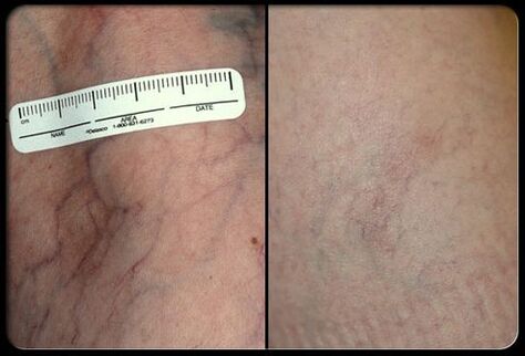 Before and after laser treatment