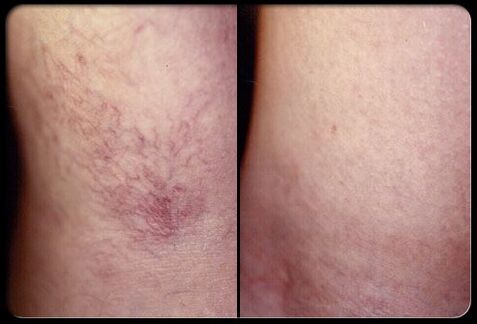 Before and after sclerosis therapy