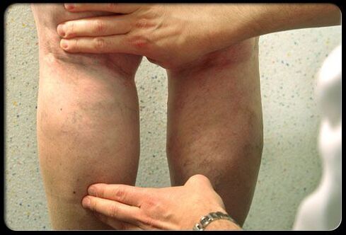 Doctors check legs with varicose veins