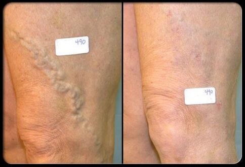 Veins before and after surgery