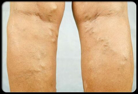 Veins on the legs