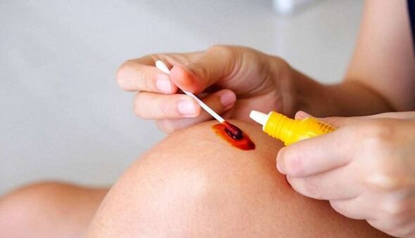 Iodine treatment for varicose veins
