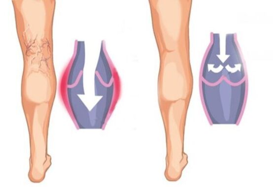 What do varicose veins look like