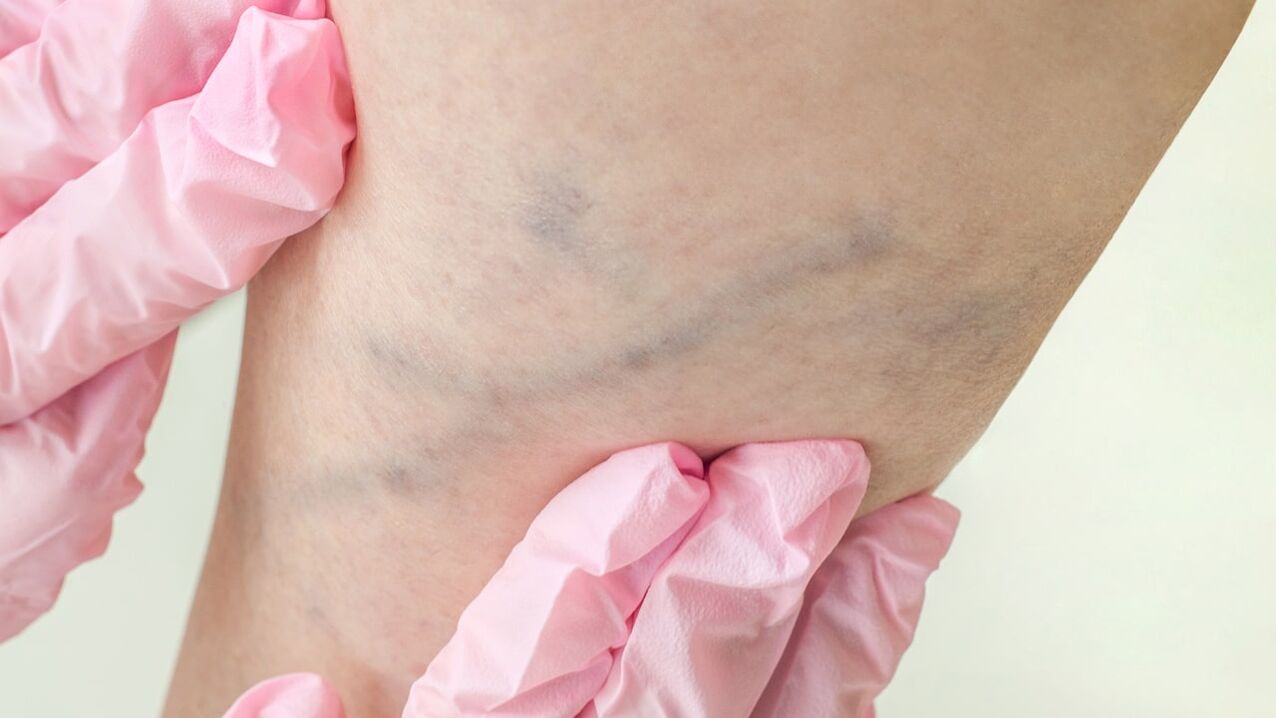 Varicose veins of lower limbs