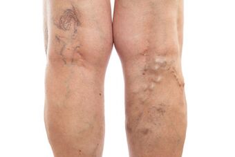 Varicose veins of lower limbs