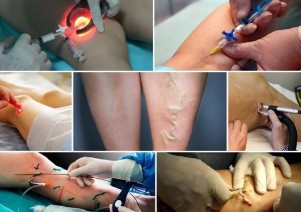 The modern methods of treatment of varicose veins