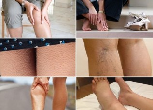 The primary symptoms of varicose veins of the veins