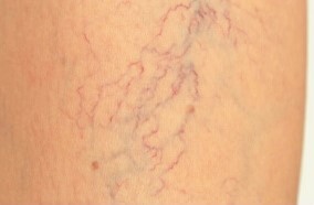 The initial stage of varicose veins
