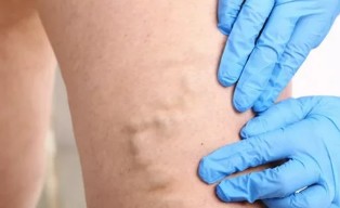 Treatment of varicose veins with the help of the bioadhesive